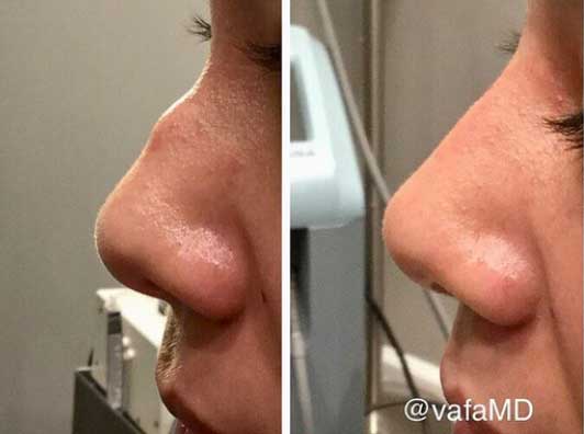 nose reshaping with fillers Larchmont before after photos